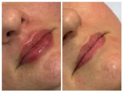 Preenchimento labial