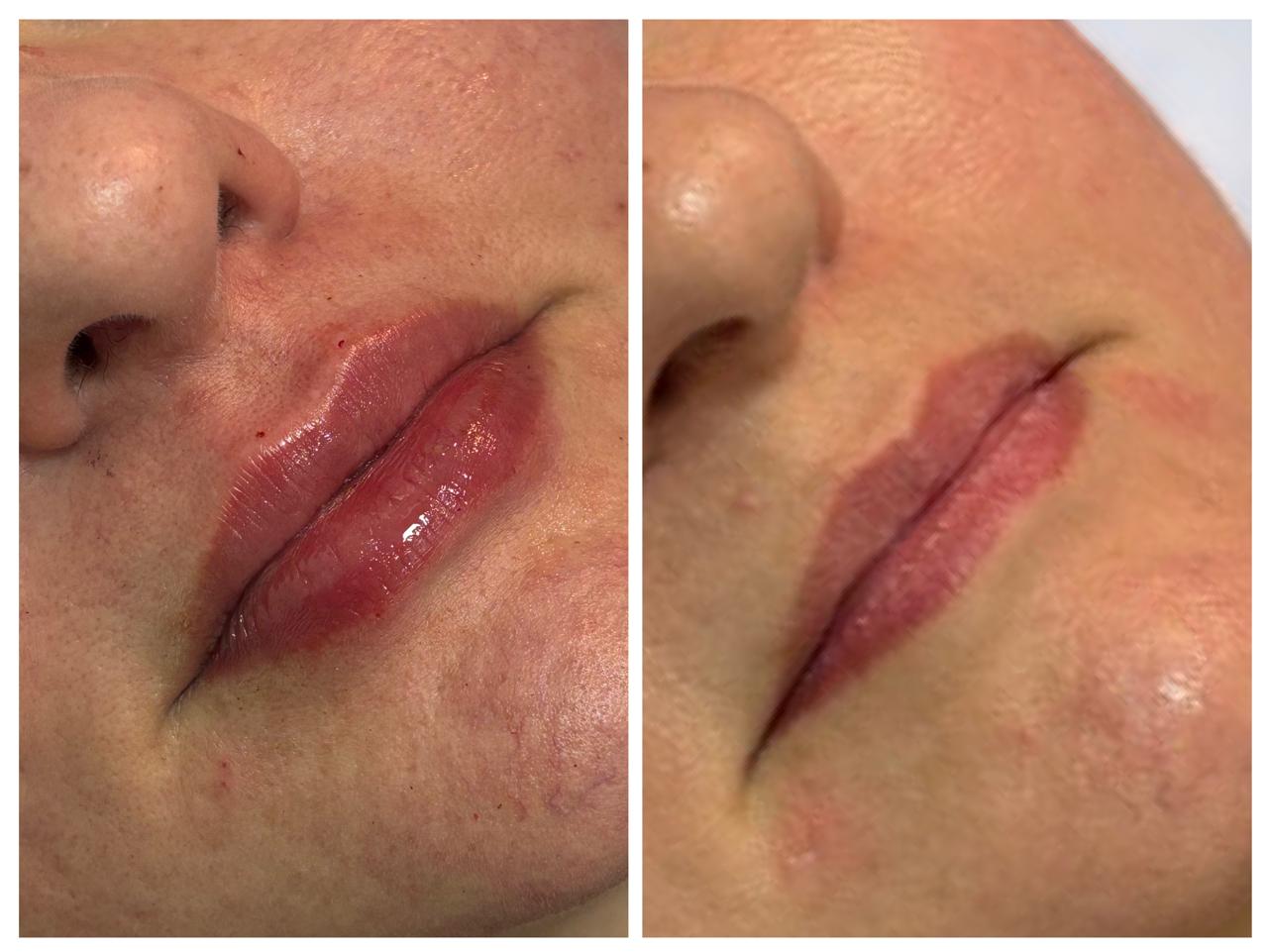 Preenchimento Facial Avançado